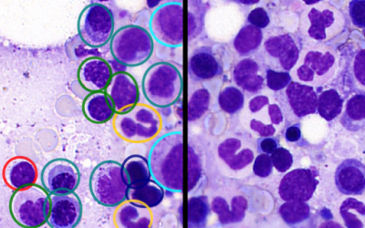 Cancilico Raises €2.5M to Scale AI-Powered Bone Marrow Diagnostics